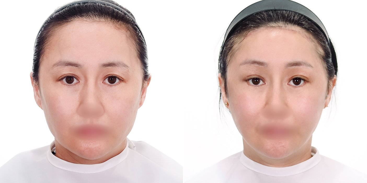Brow Lift Case 1 — Endoscopic brow lift