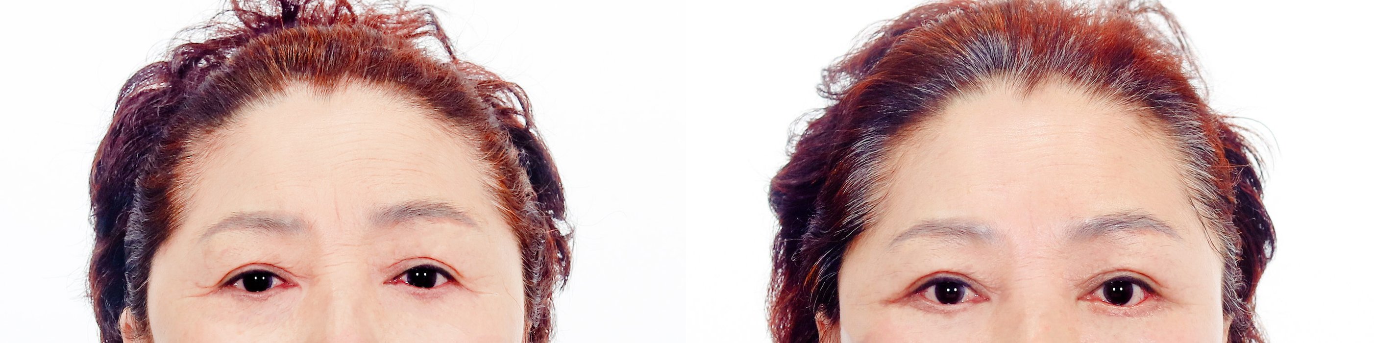 Brow Lift Case 2 — Direct brow lift