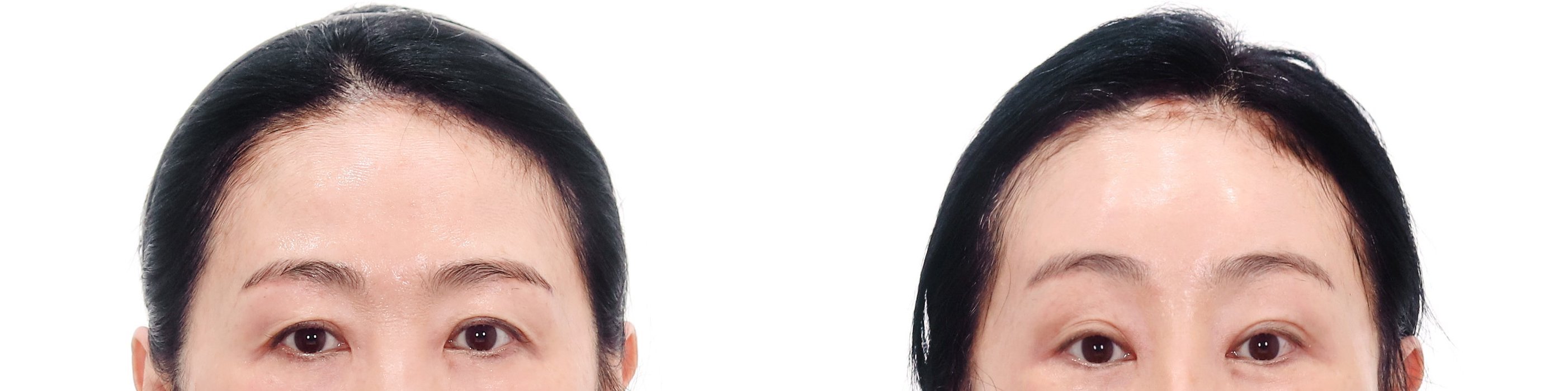 Brow Lift Case 3 — Temporal lift