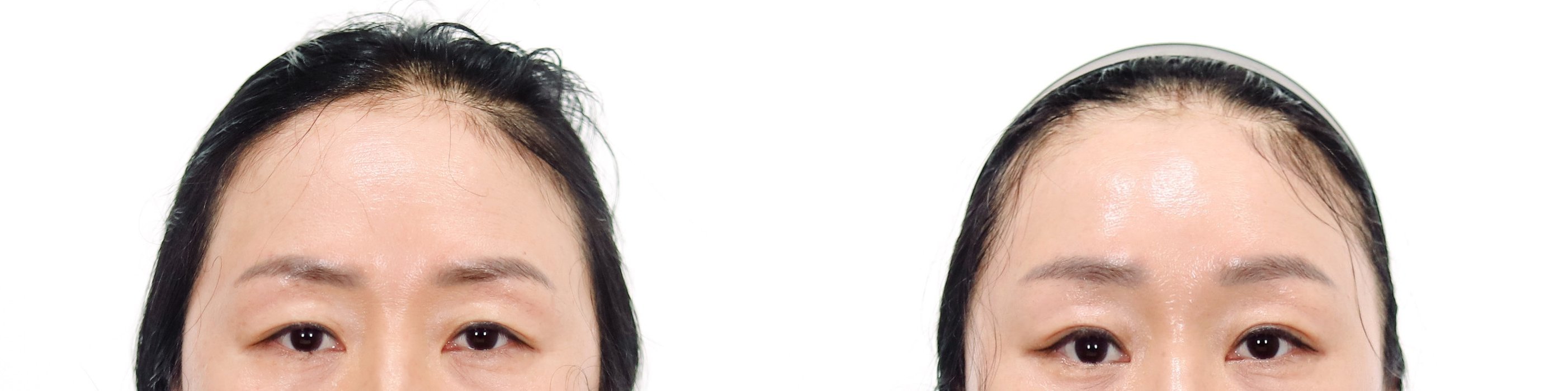 Brow Lift Case 4 — Forehead lift