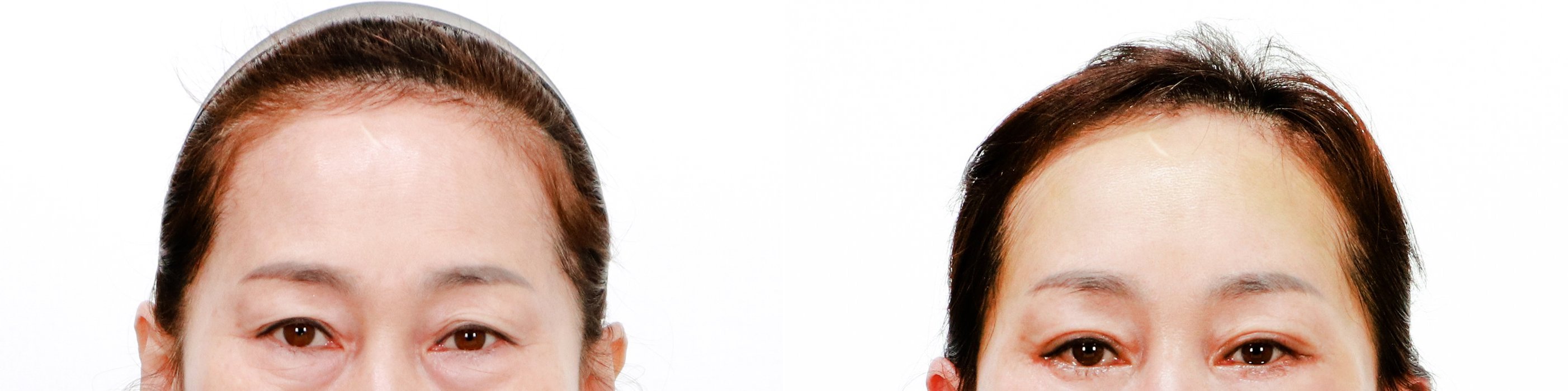 Brow Lift Case 5 — Coronal brow lift