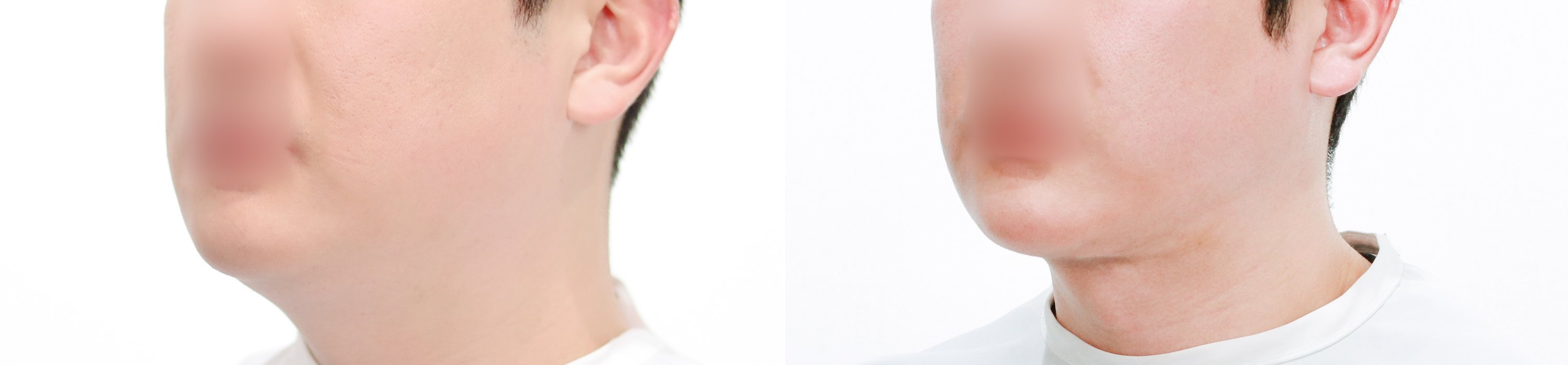 Double Chin Case 1 — Submental liposuction