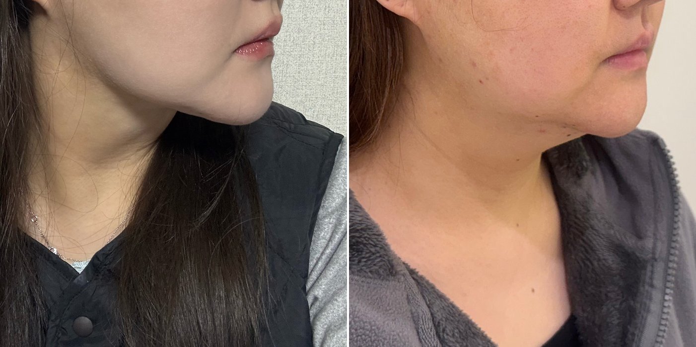 Double Chin Case 3 — Fat removal