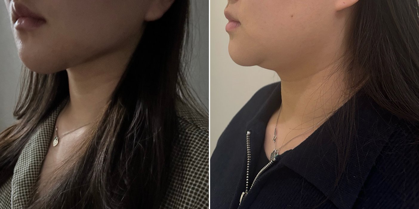 Double Chin Case 4 — Chin contouring
