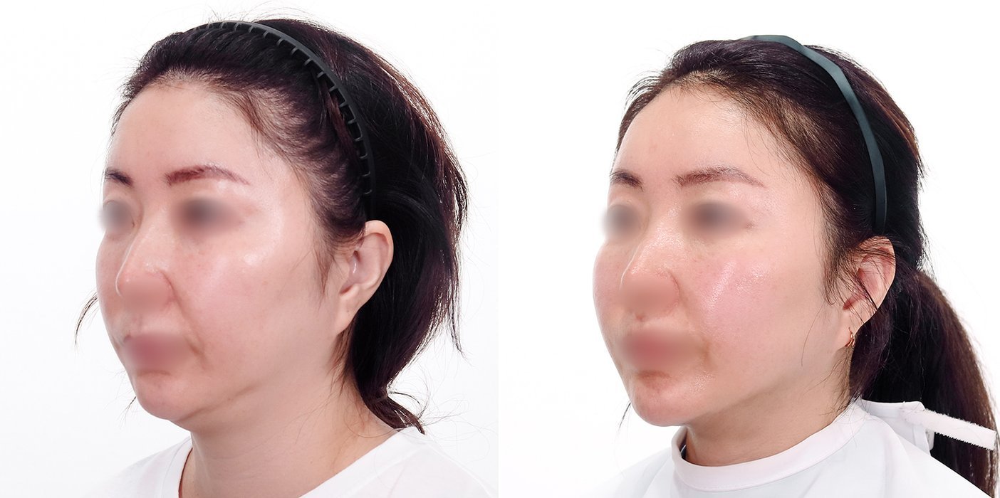 Double Chin Case 5 — Submental suction