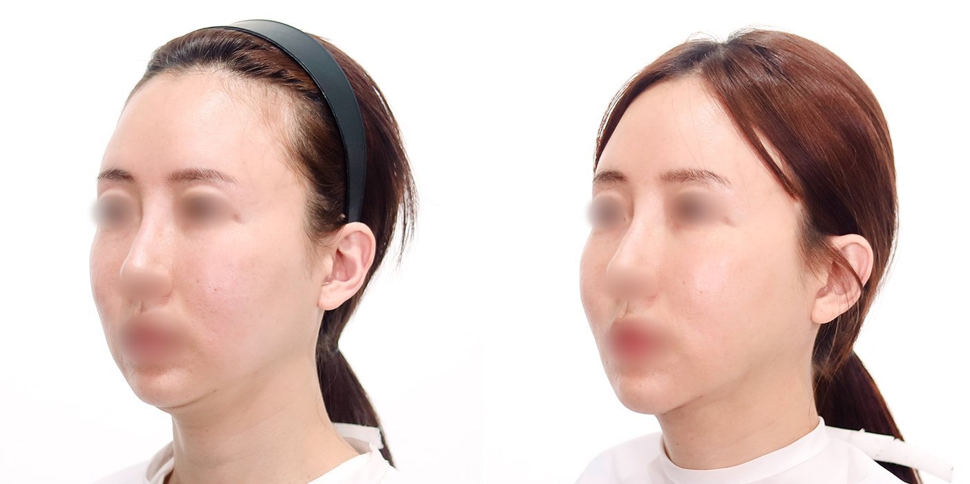 Double Chin Case 6 — Neck liposuction