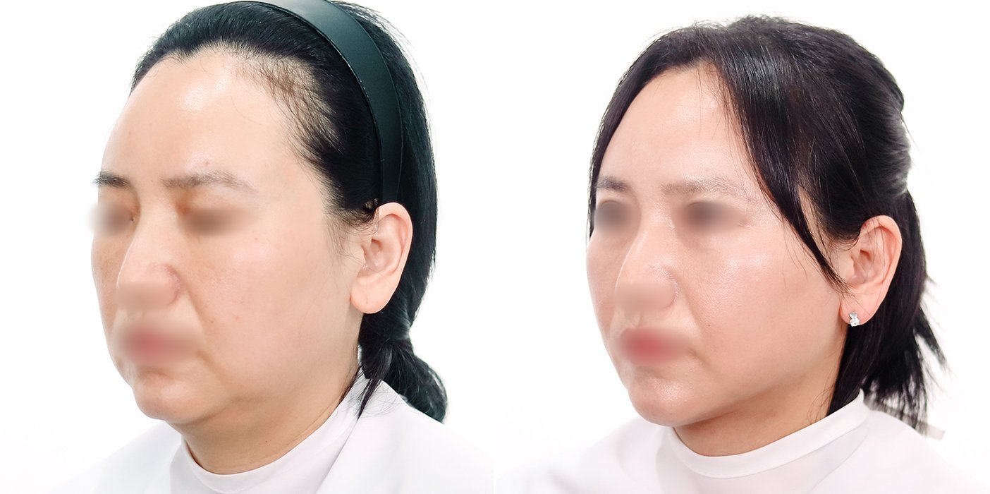 Double Chin Case 7 — Jawline definition