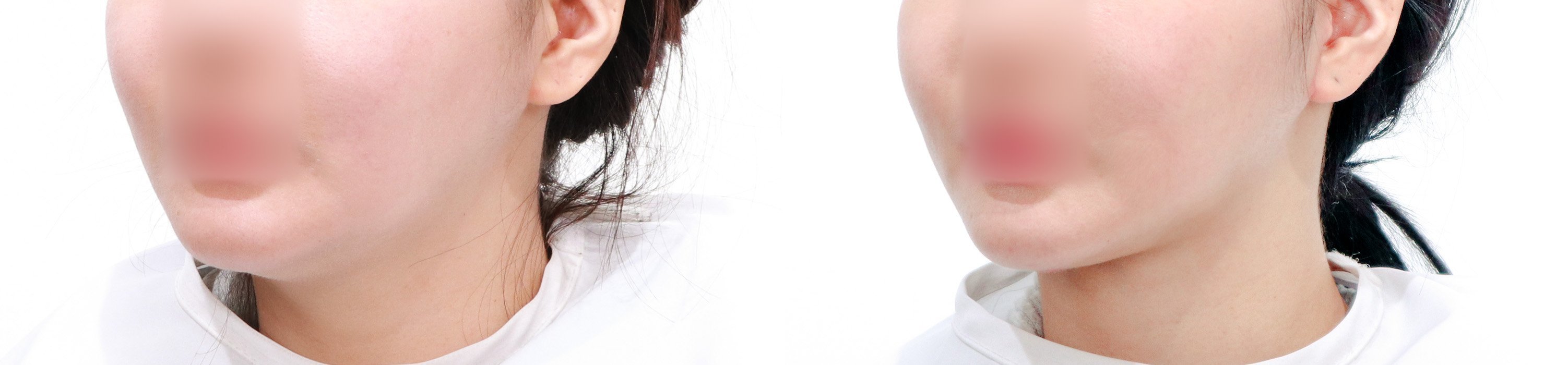 Double Chin Case 8 — Full chin sculpting