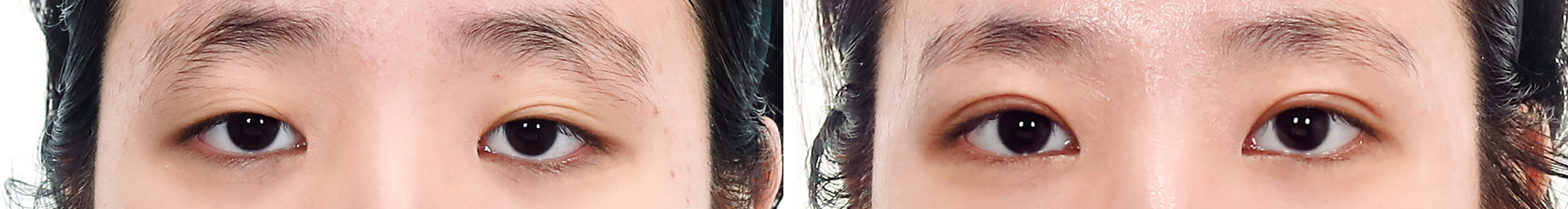 Double Eyelid Case 1 — Incisional method