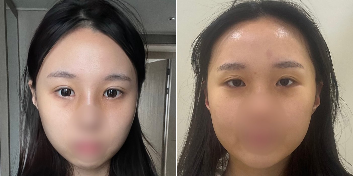 Double Eyelid Case 2 — Non-incisional