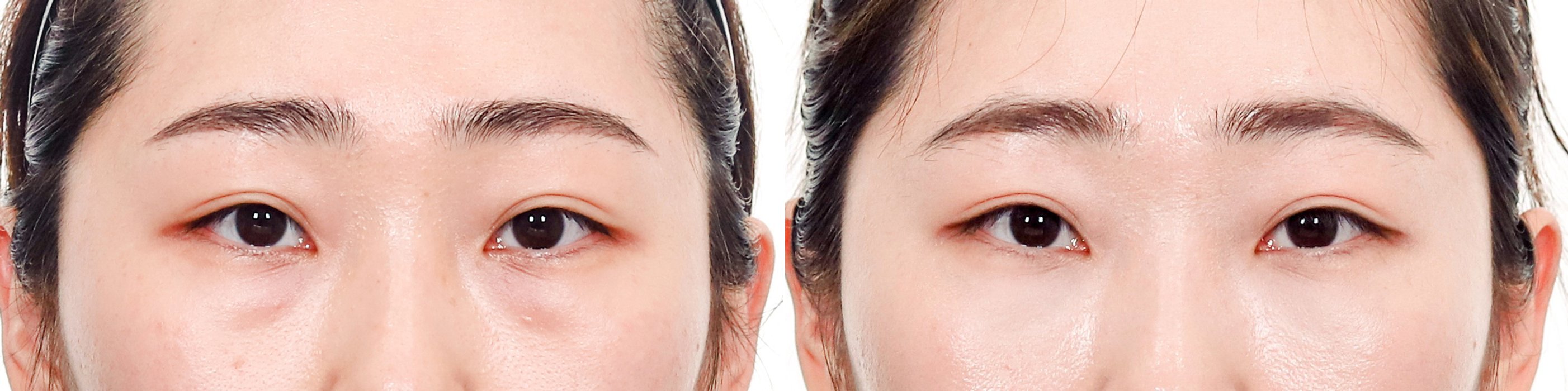 Under-Eye Case 1 — Fat repositioning