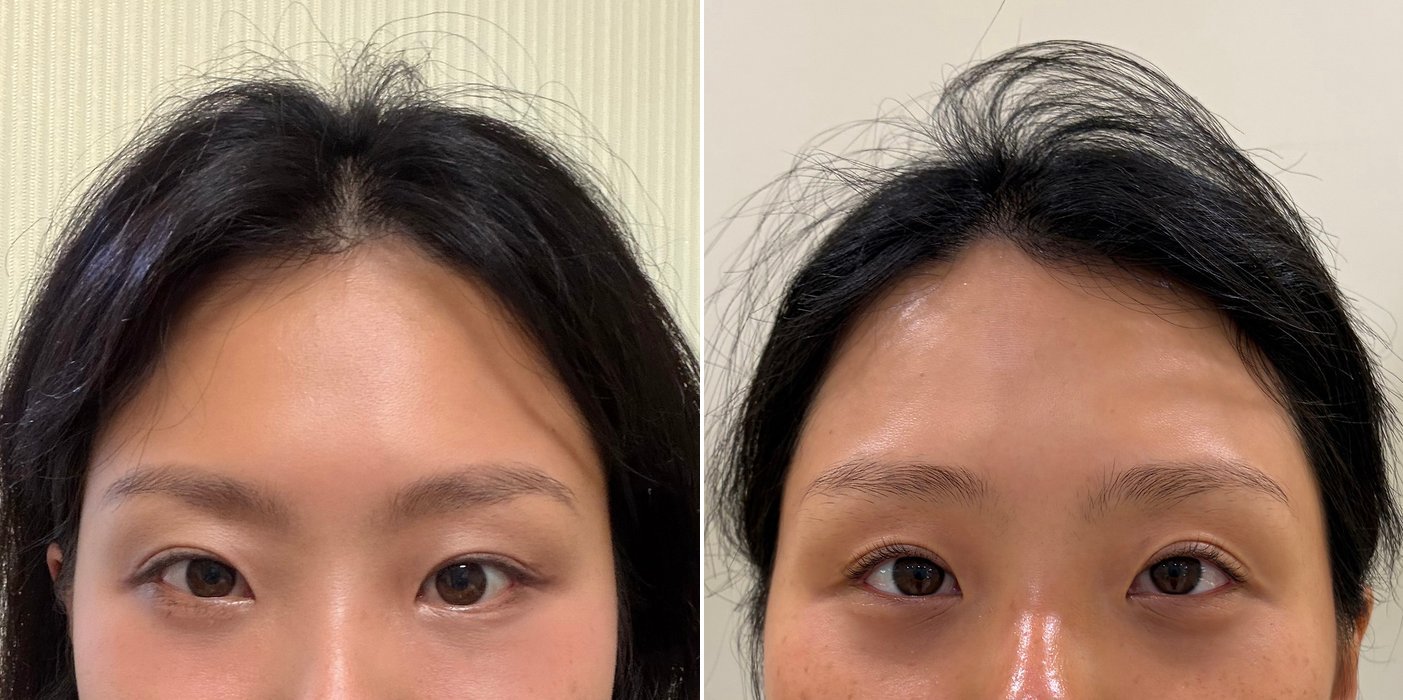 Under-Eye Case 2 — Lower blepharoplasty