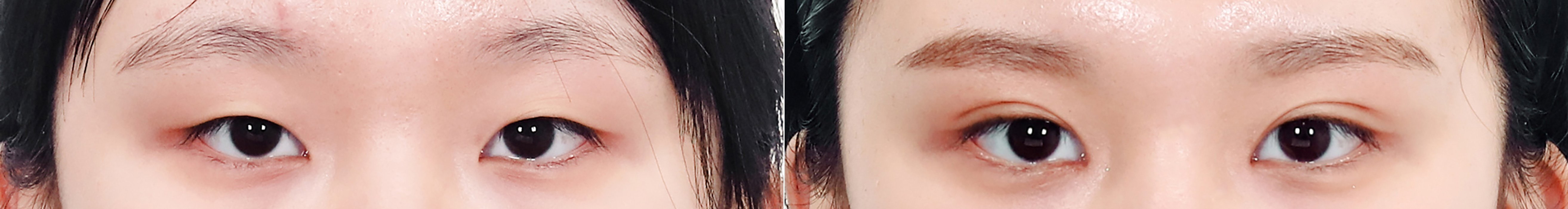 Double Eyelid Case 3 — Ptosis correction