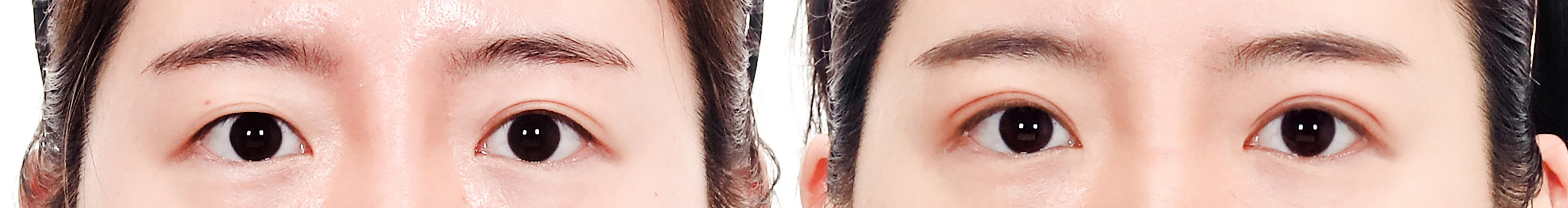 Double Eyelid Case 4 — Incisional revision