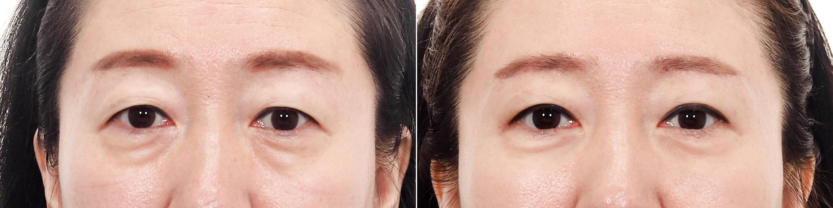 Under-Eye Case 3 — Fat removal