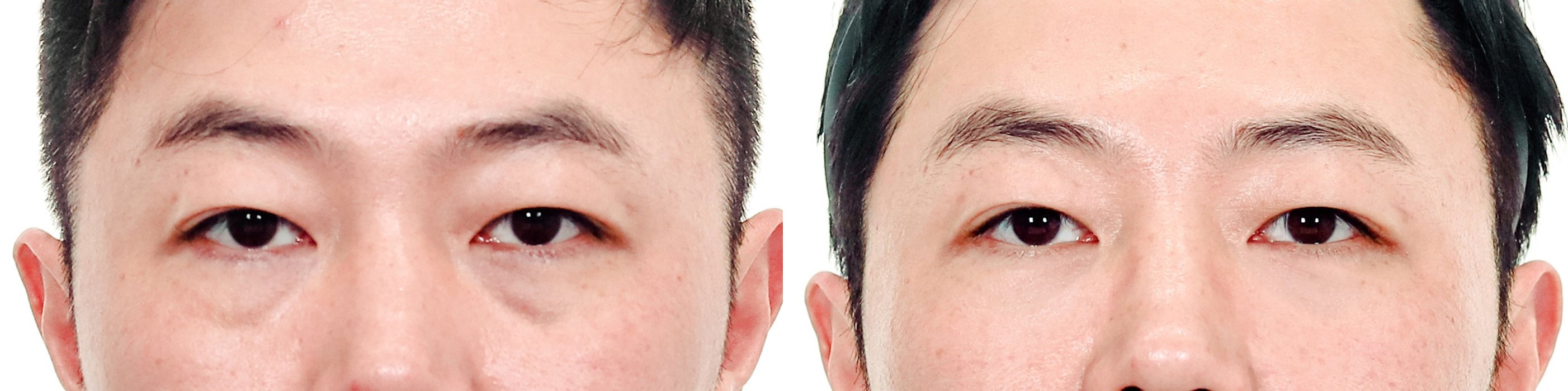 Under-Eye Case 4 — Dark circle correction