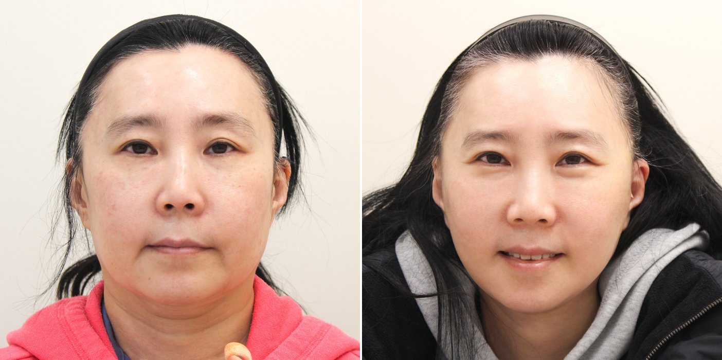 Facelift Case 1 — SMAS facelift