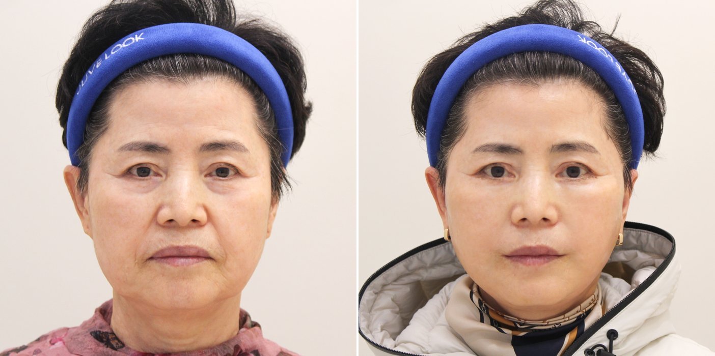 Facelift Case 2 — Deep plane lift