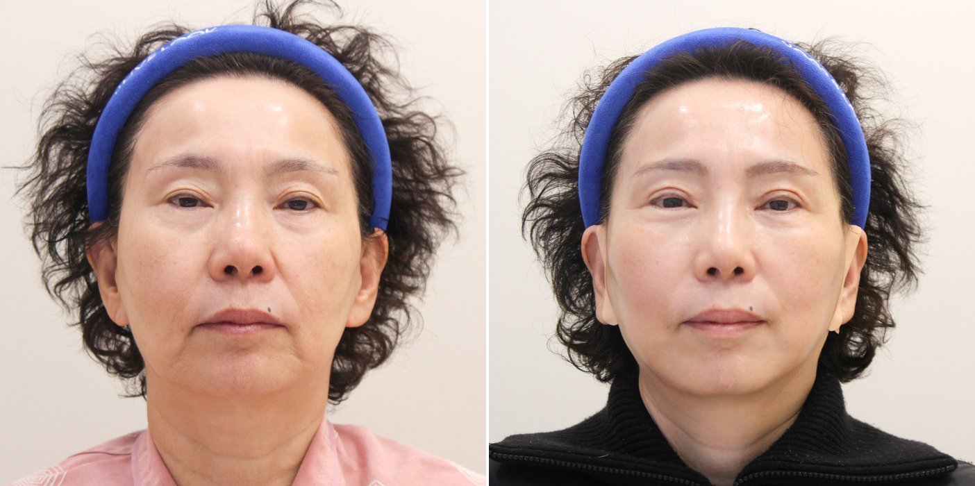 Facelift Case 3 — Lower face lift
