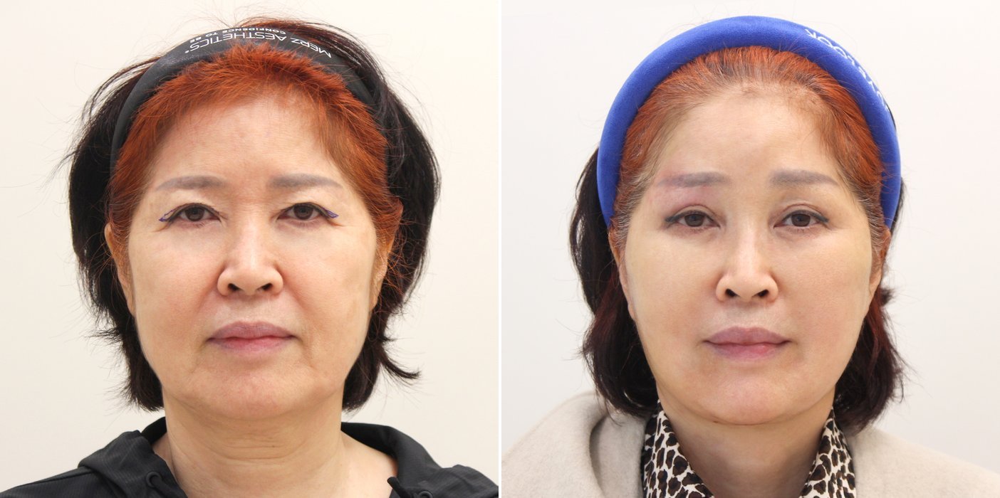 Facelift Case 4 — SMAS facelift
