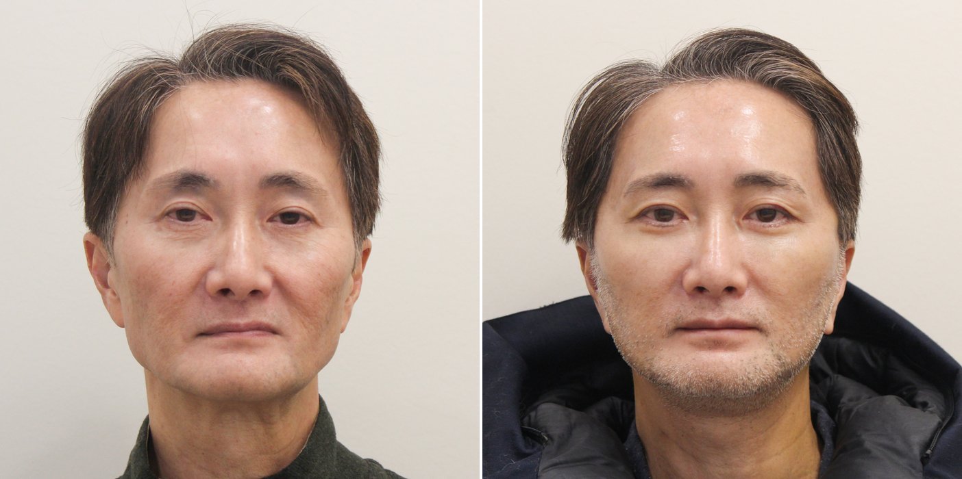 Facelift Case 5 — Mid-face lift