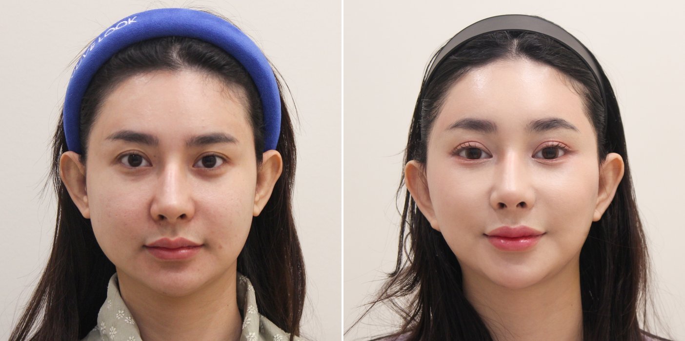 Facelift Case 6 — Full SMAS lift