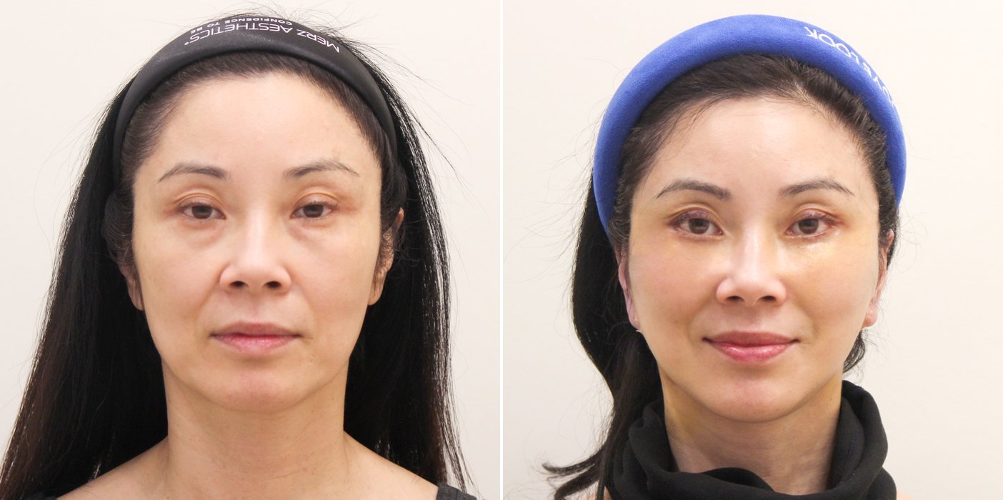 Facelift Case 7 — Lower face and neck