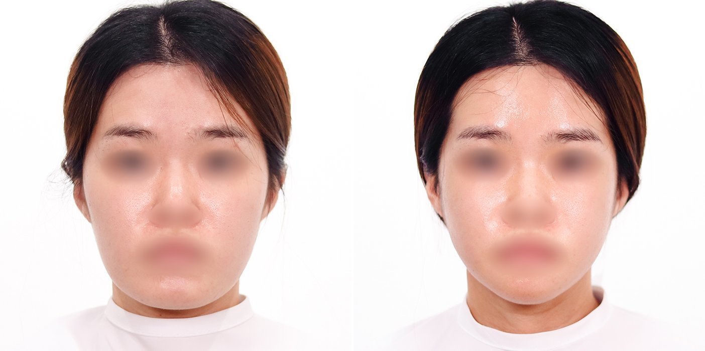 Contouring Case 1 — V-line jaw reduction