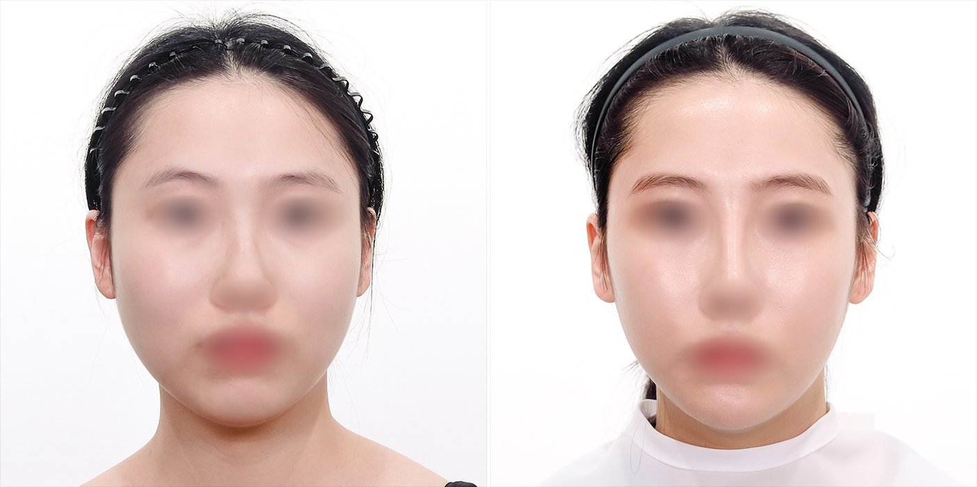 Contouring Case 2 — Zygoma + mandible
