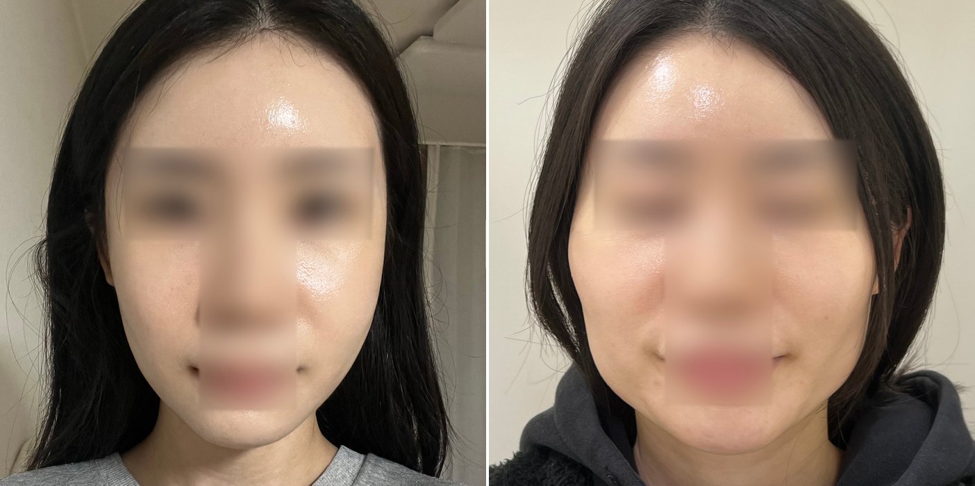 Contouring Case 3 — Jaw reduction