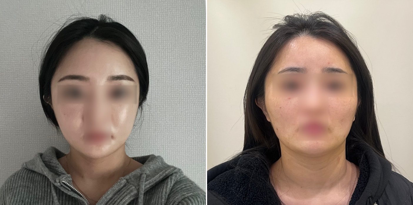 Contouring Case 4 — Full contouring