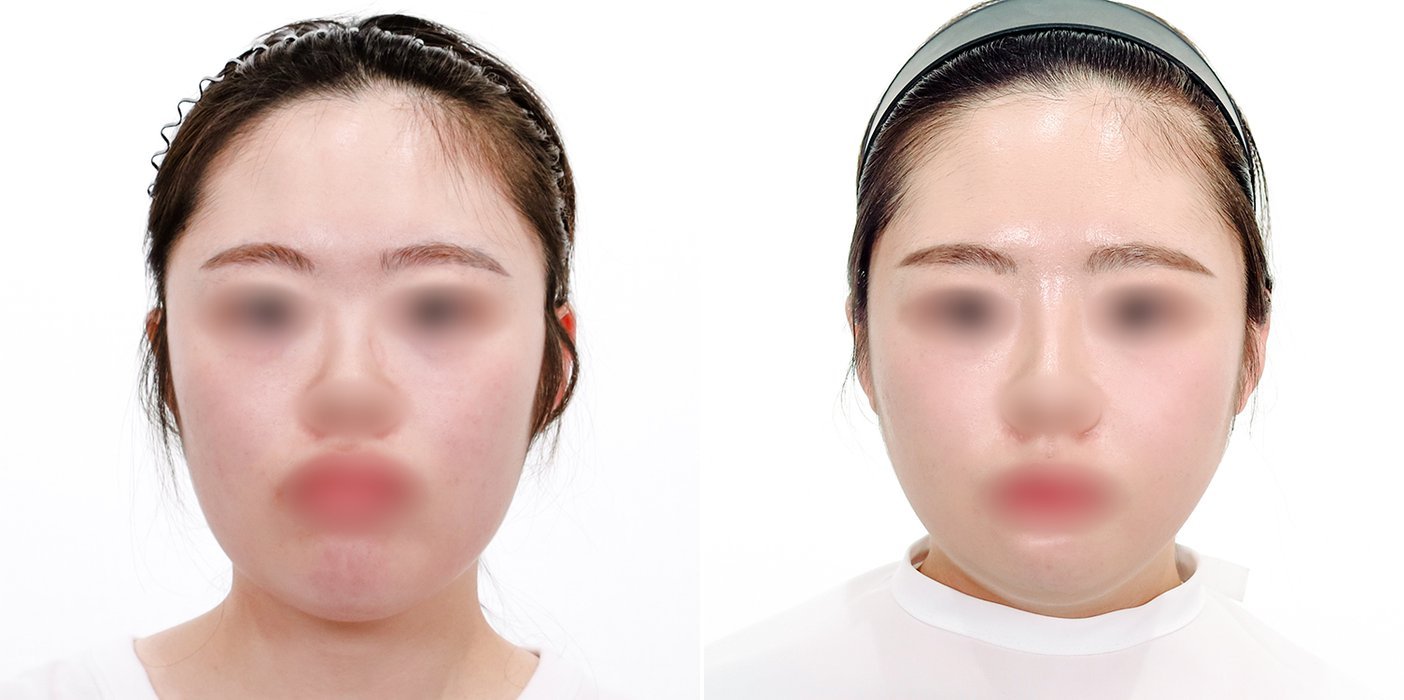 Contouring Case 5 — Square jaw reduction