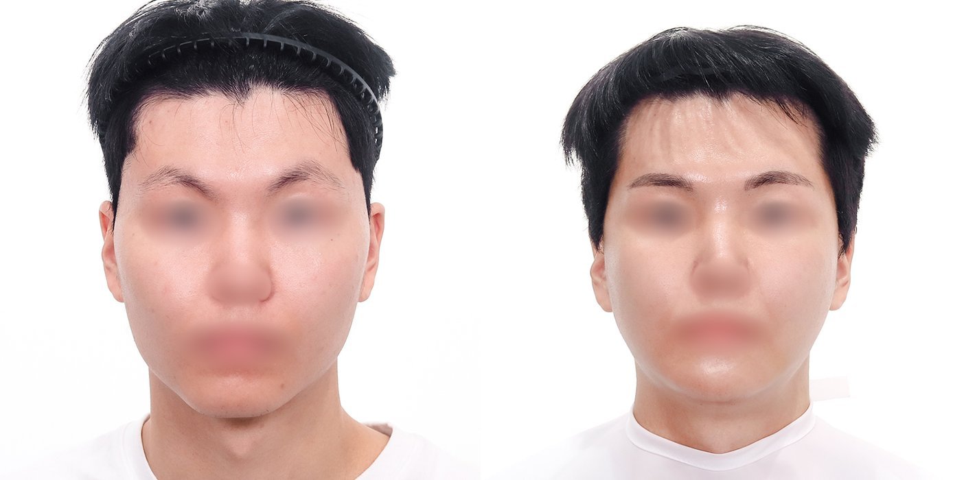 Contouring Case 6 — Cheekbone reduction