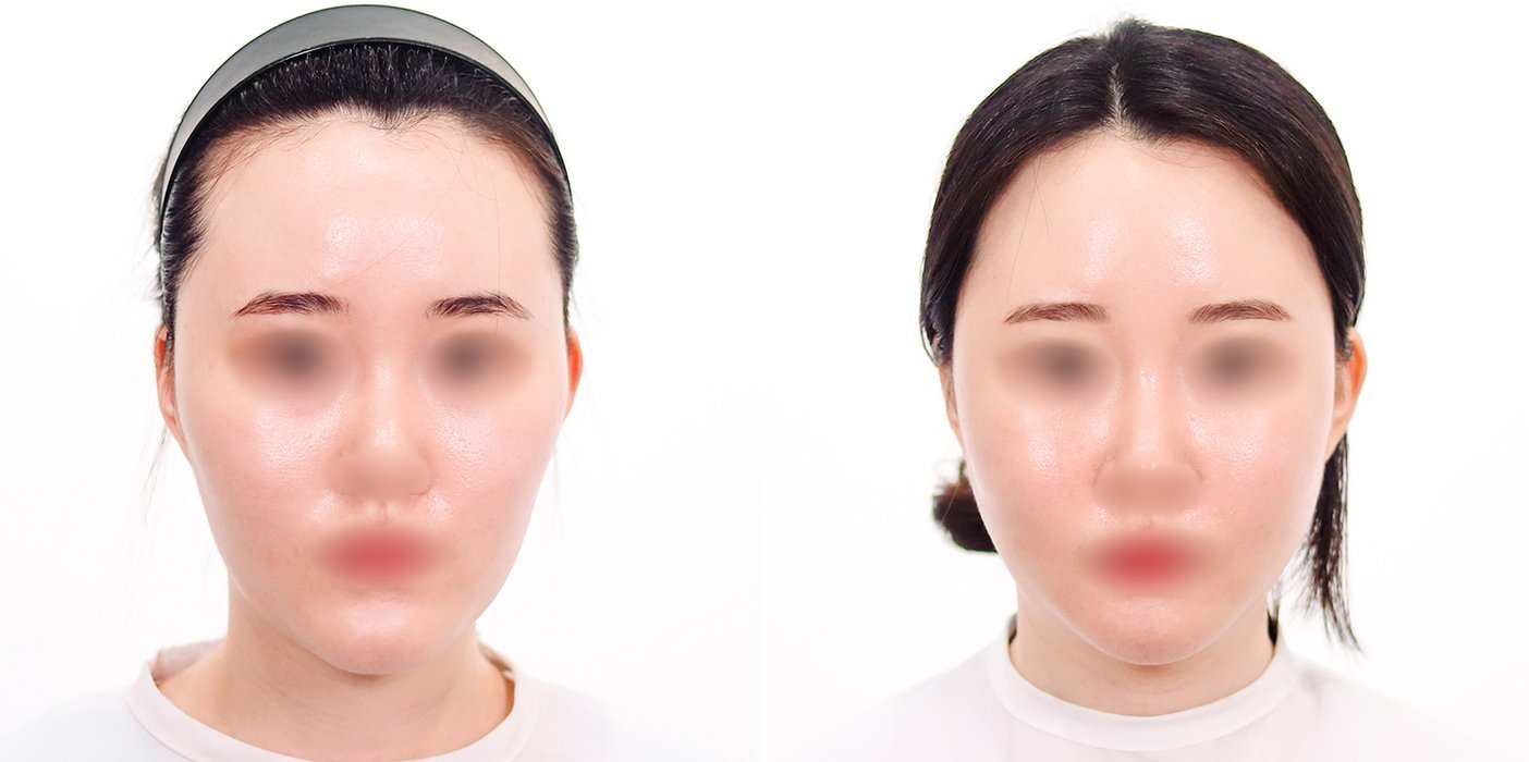 Contouring Case 7 — Mandible contouring