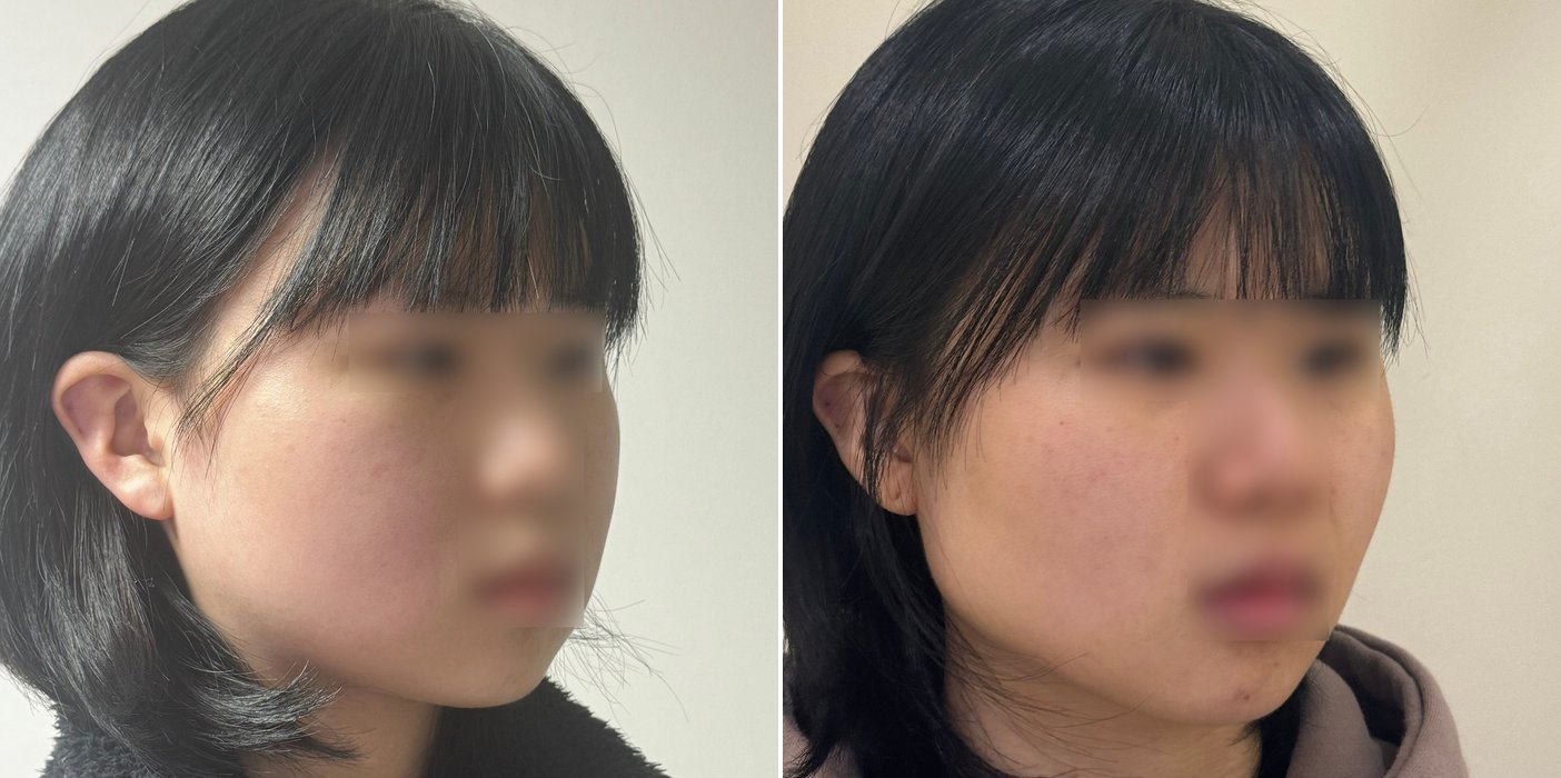 Contouring Case 8 — Mini V-line