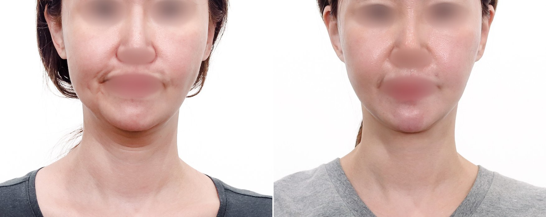 Neck Lift Case 1 — Platysmaplasty