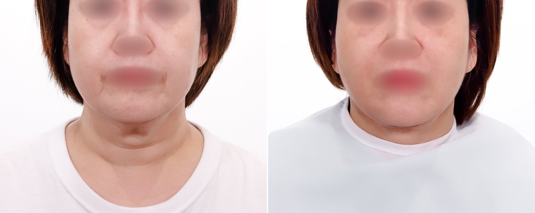 Neck Lift Case 2 — Cervicoplasty