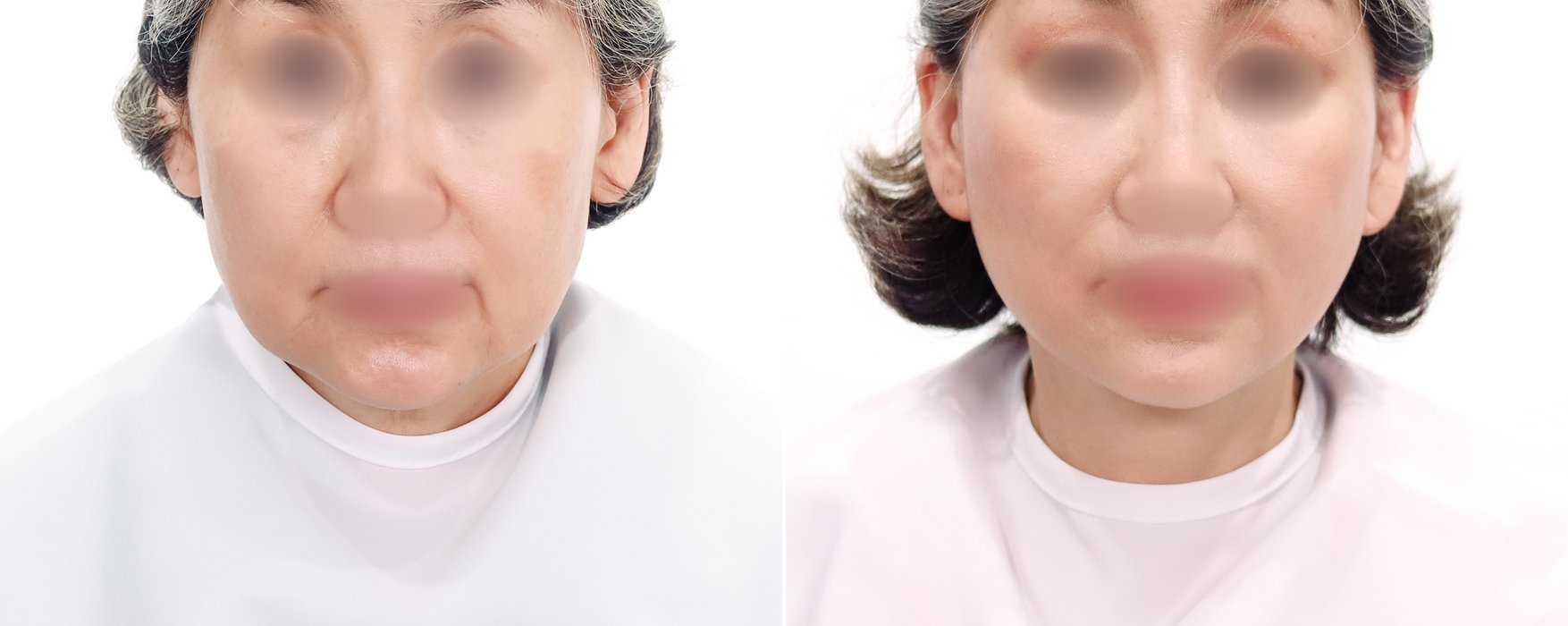 Neck Lift Case 3 — Neck contouring