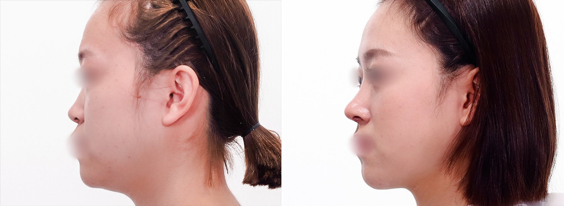Rhinoplasty Case 1 — Bridge and tip correction
