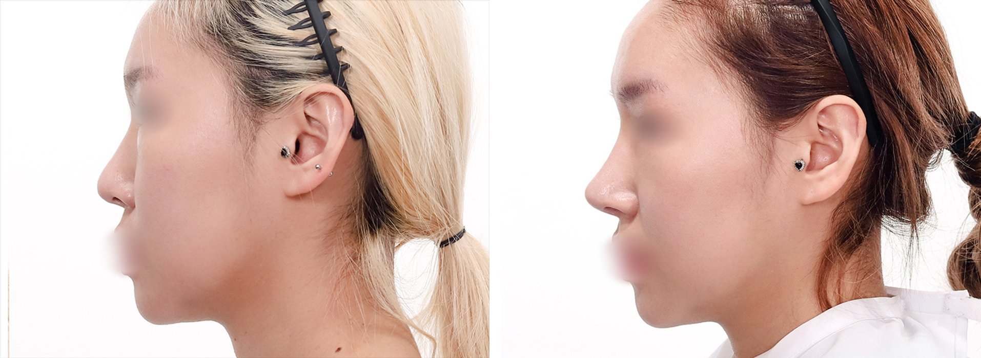 Rhinoplasty Case 2 — Dorsal hump reduction