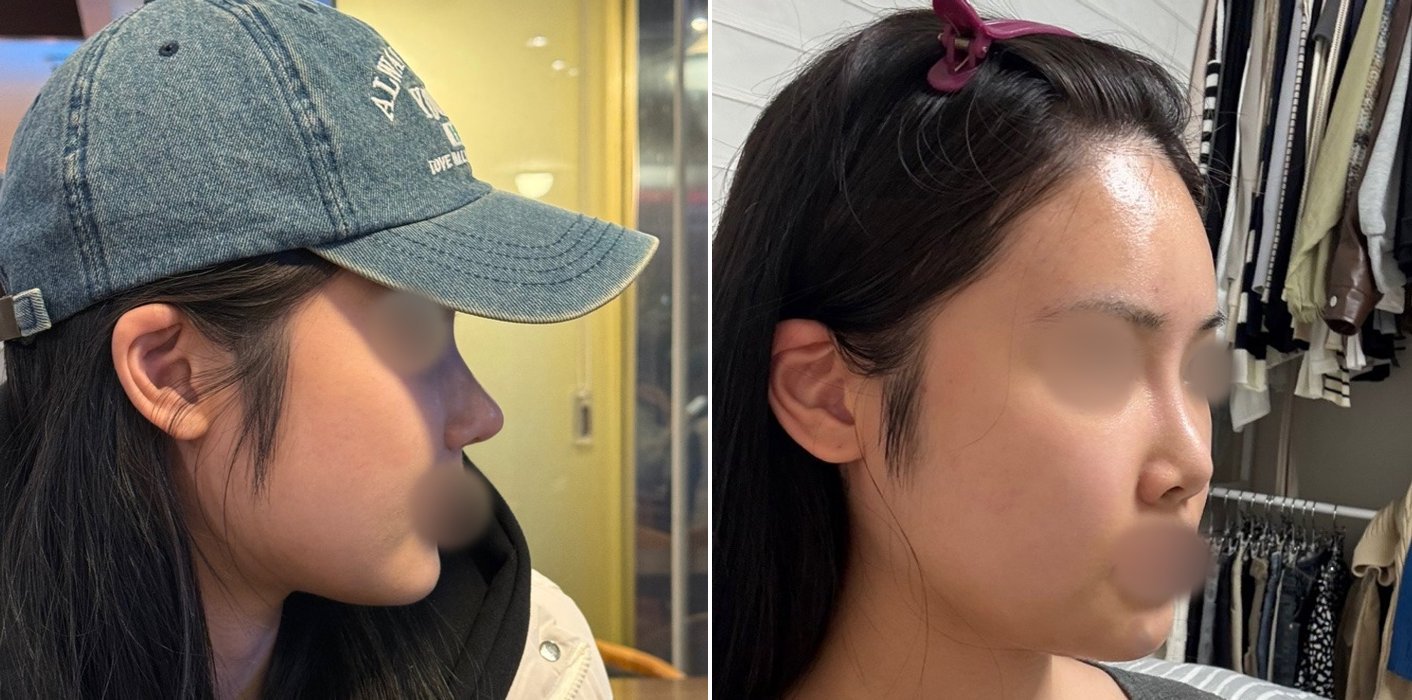 Rhinoplasty Case 3 — Tip refinement