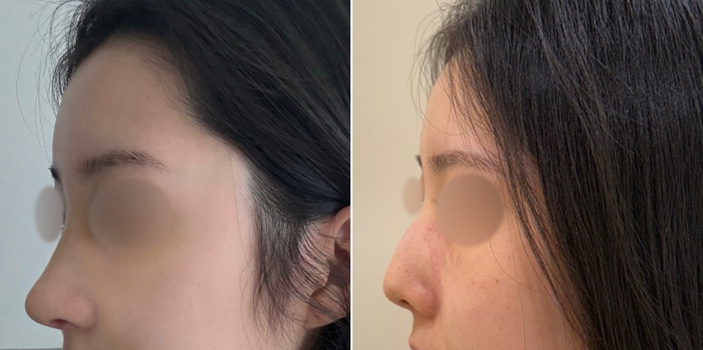 Rhinoplasty Case 4 — Full rhinoplasty