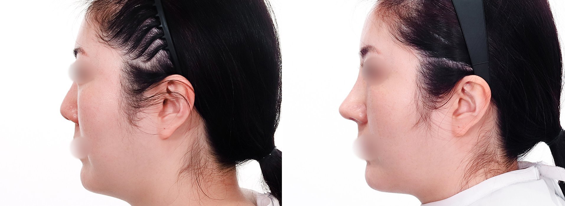 Rhinoplasty Case 5 — Bridge straightening