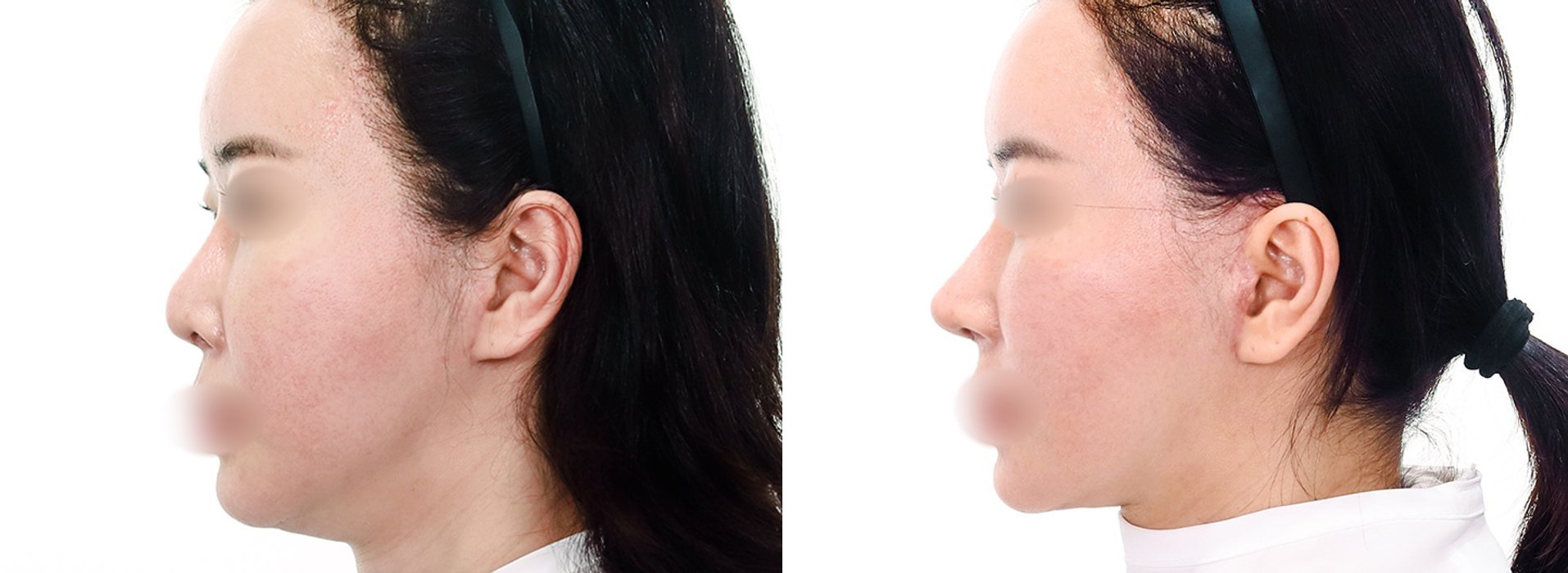 Rhinoplasty Case 6 — Alar reduction