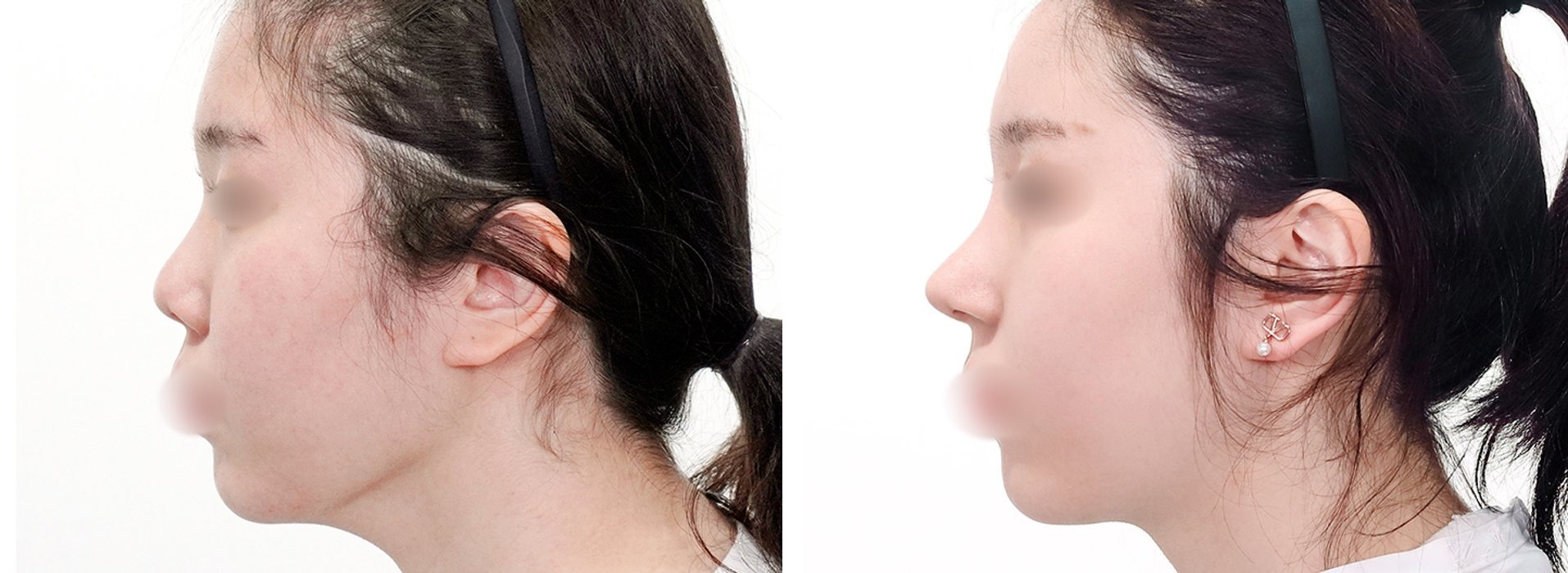 Rhinoplasty Case 7 — Deviated septum correction