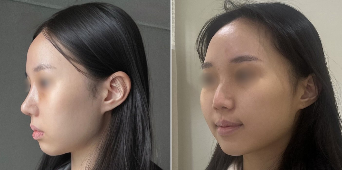 Rhinoplasty Case 8 — Revision rhinoplasty