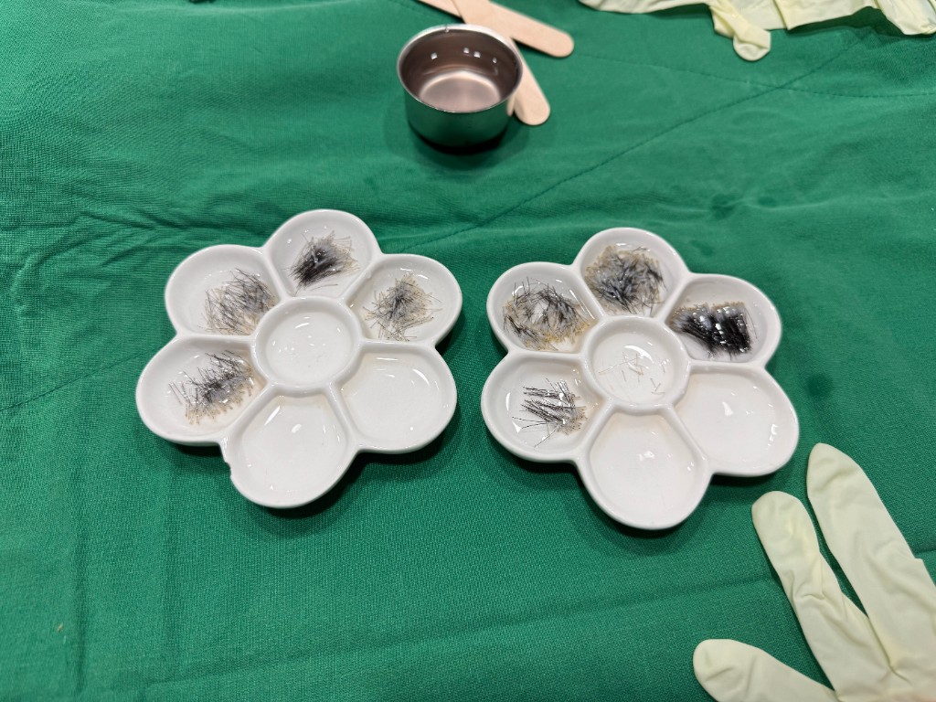 Follicular grafts sorted for transplantation