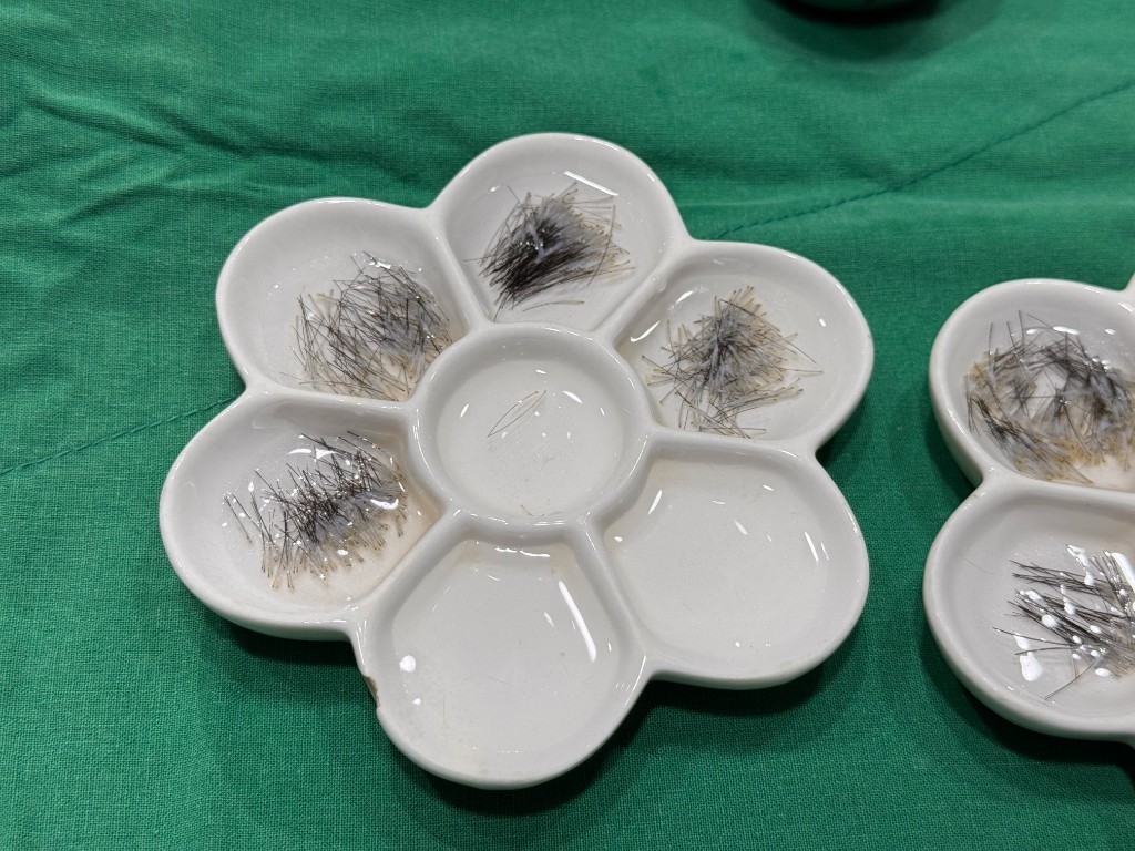 Follicular grafts sorted for transplantation