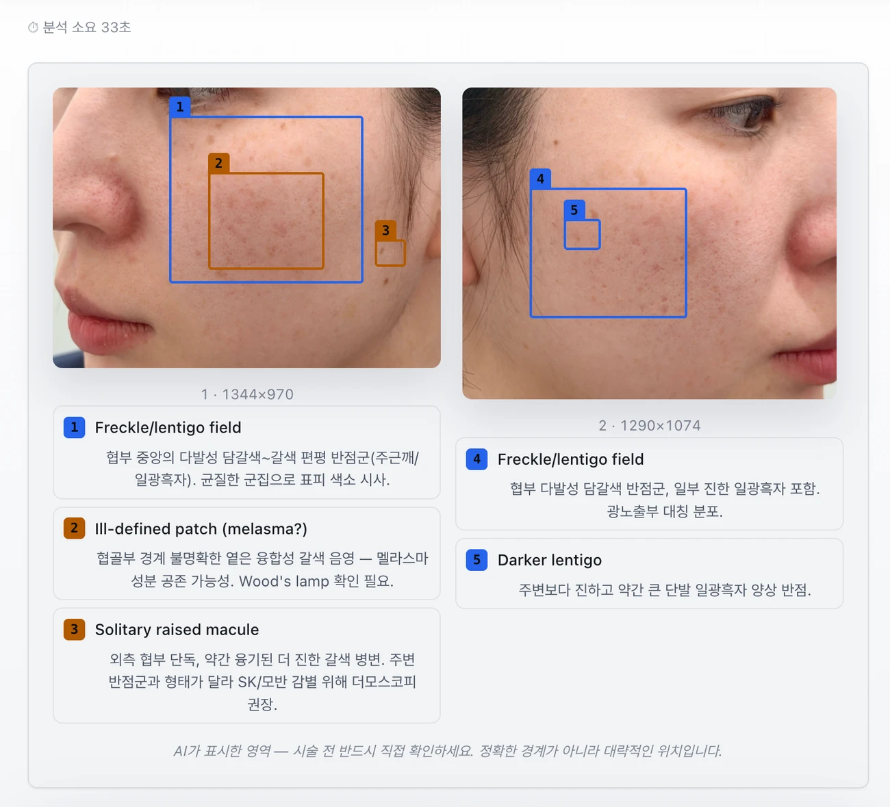 DermatoScan AI Lesion analysis